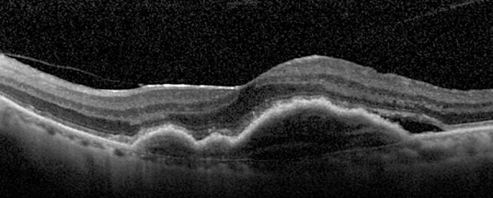 Les protocoles thérapeutiques dans la DMLA exsudative