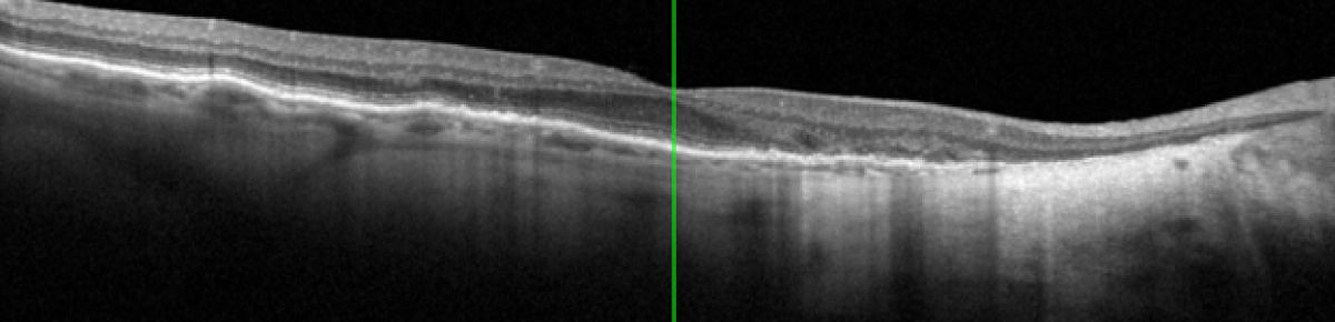 L'OCT : les bases essentielles pour bien réaliser vos examens