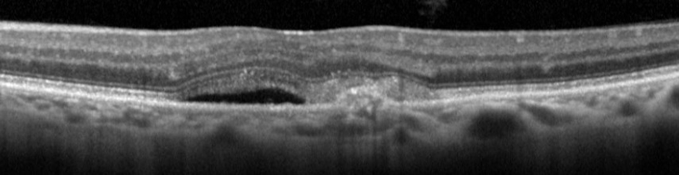 L'OCT et l'OCT-A dans la DMLA
