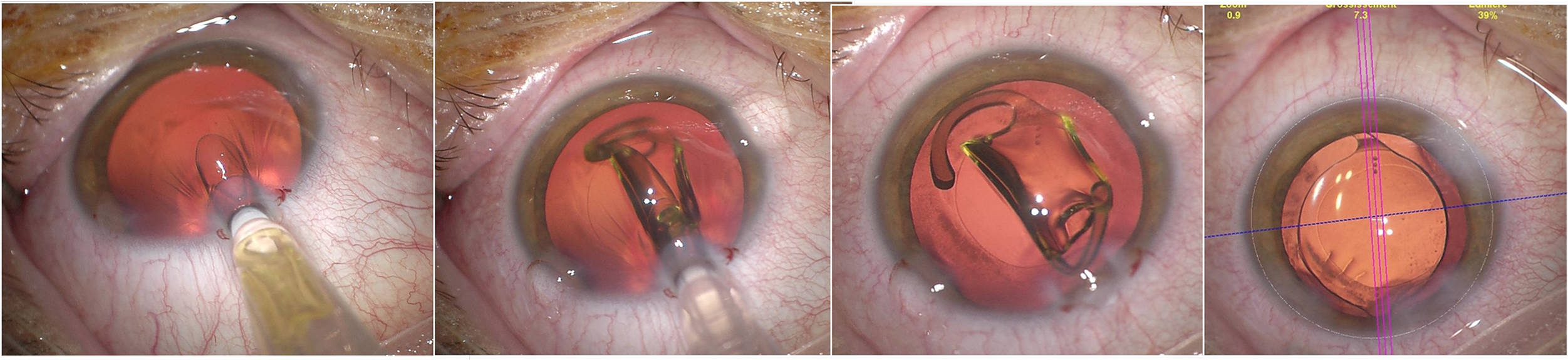 Bon usage des implants toriques dans la chirurgie de la cataracte