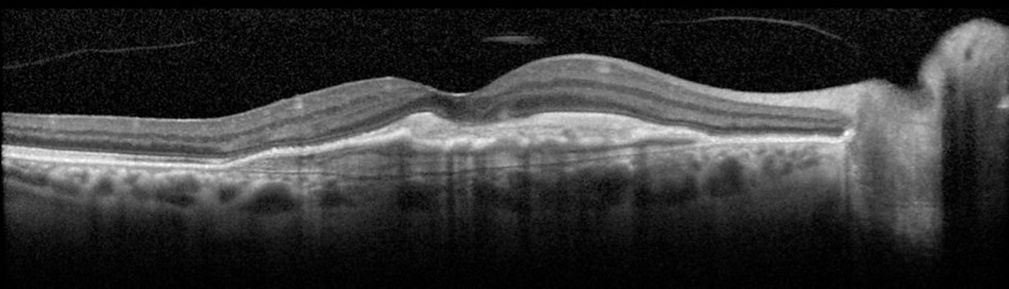 Examens complémentaires : OCT dans la DMLA, Pré-requis en OCT-A,  OCT-A dans la DMLA et CV dans le glaucome