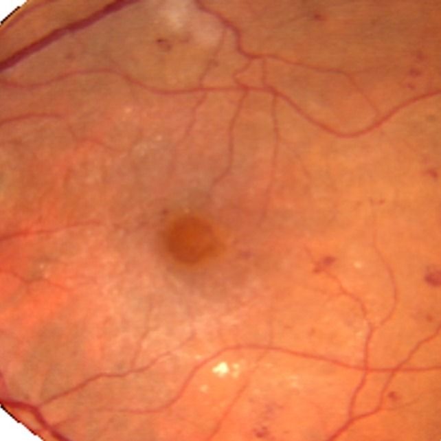 Indications chirurgicales dans la rétinopathie diabétique