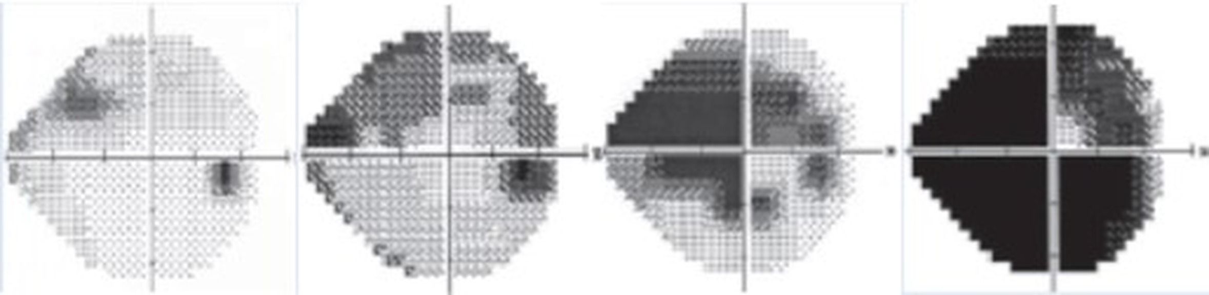 Champ visuel et glaucome
