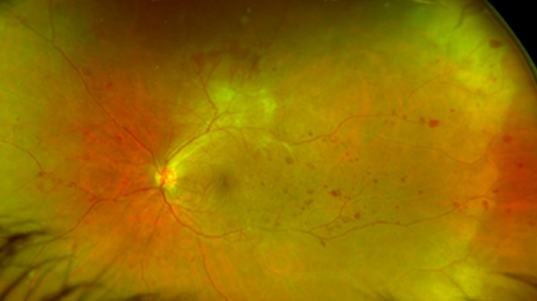 Place des anti-VEGF dans la prise en charge de la rétinopathie diabétique