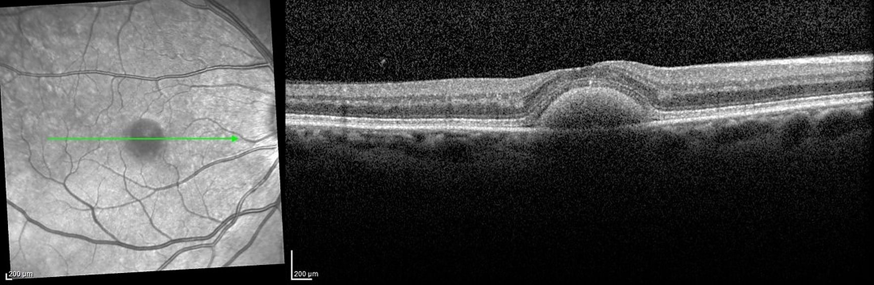 Les dystrophies maculaires héréditaires, quels examens pour orienter le diagnostic ?