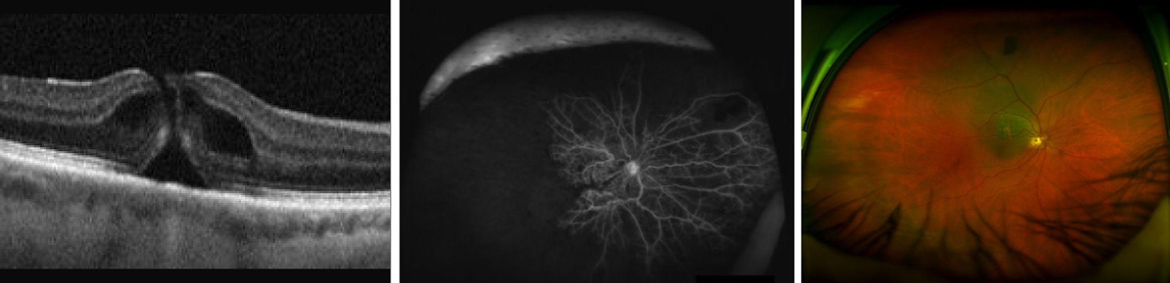 Quels examens pour quelles pathologies rétiniennes ?