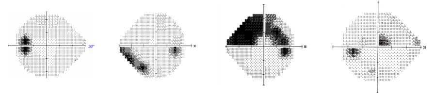 Champ visuel : tout ce qu'il faut savoir pour bien commencer