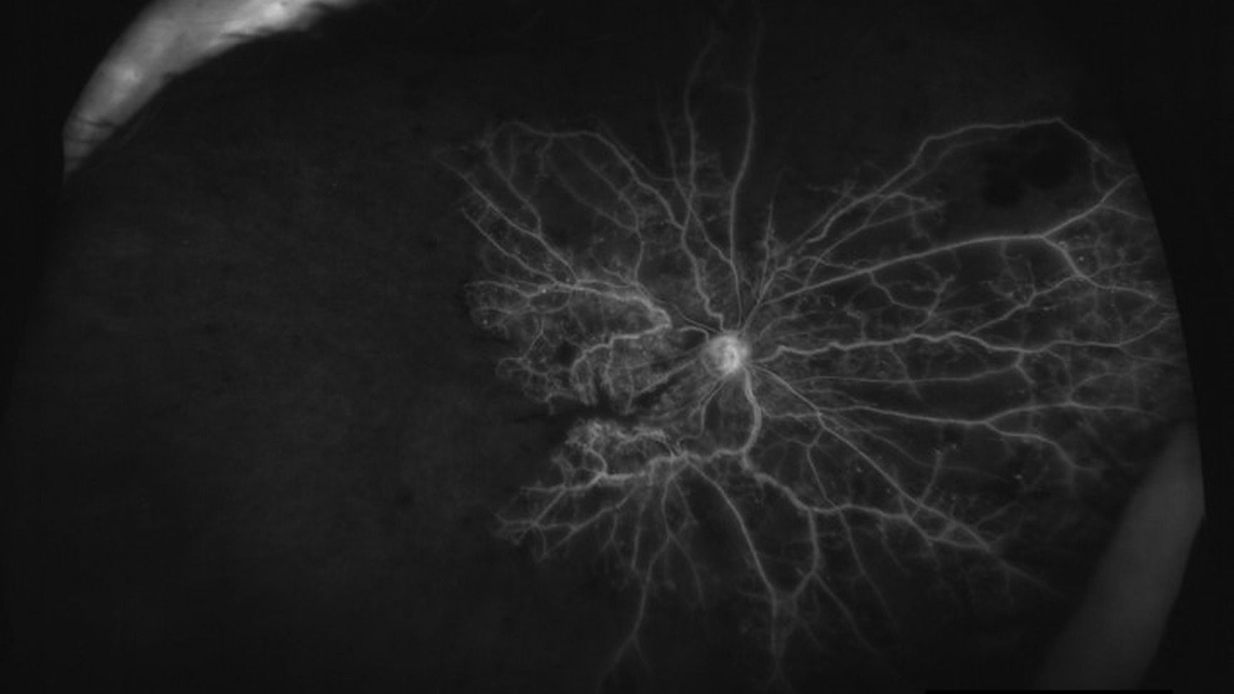 Quels examens pour le diagnostic et le suivi des occlusions veineuses rétiniennes ?