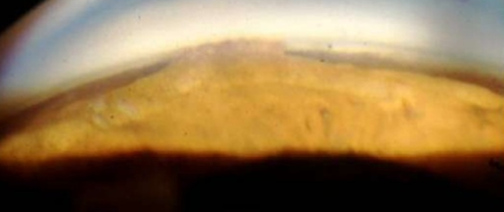 Détection et diagnostic des glaucomes à angle fermé