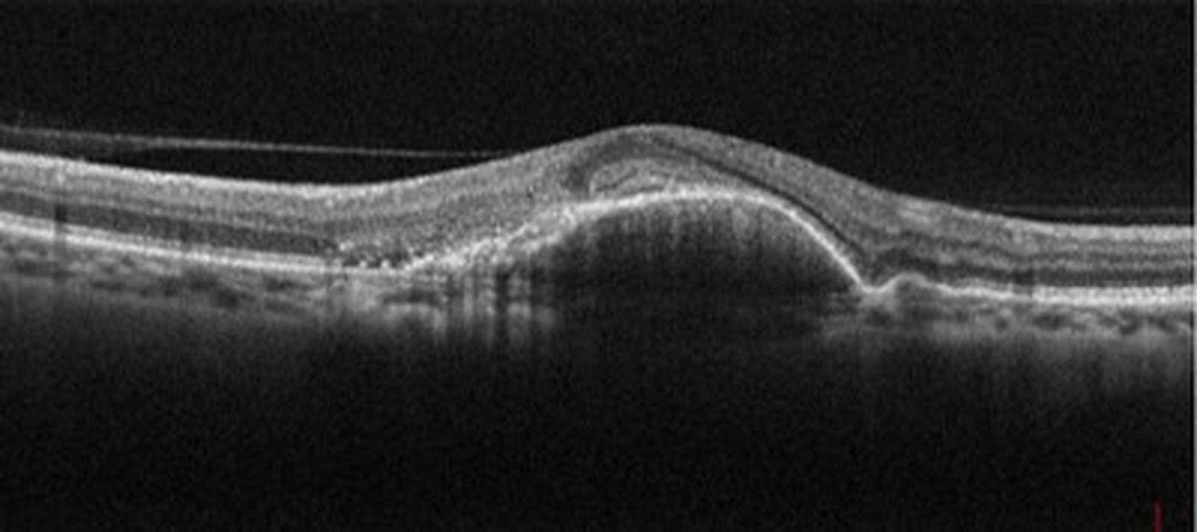 Diagnostics différentiels de la DMLA