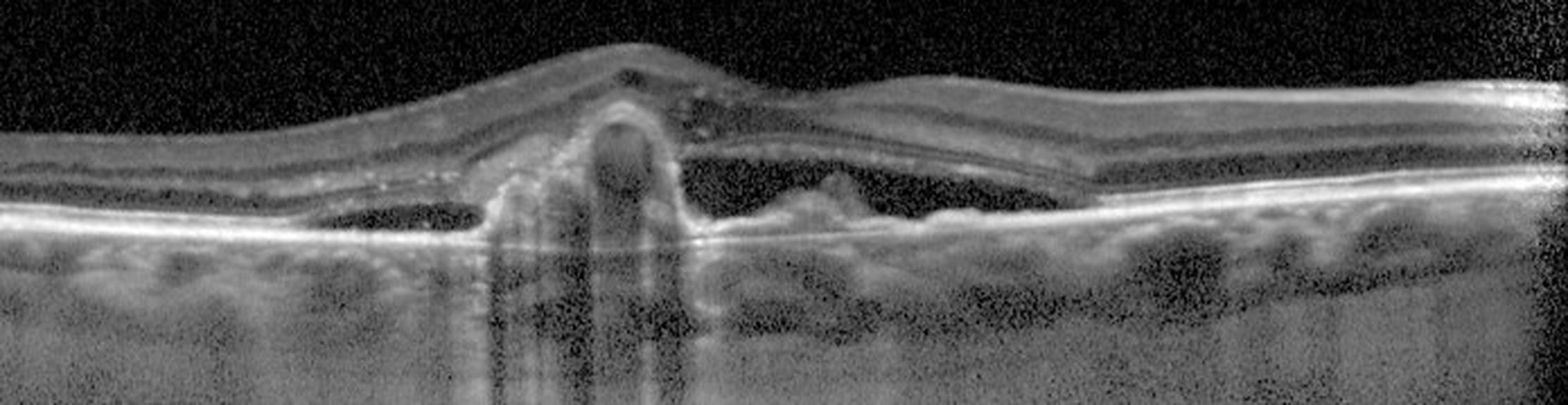 Diagnostic différentiel de la DMLA : la vasculopathie polypoïdale choroïdienne VPC
