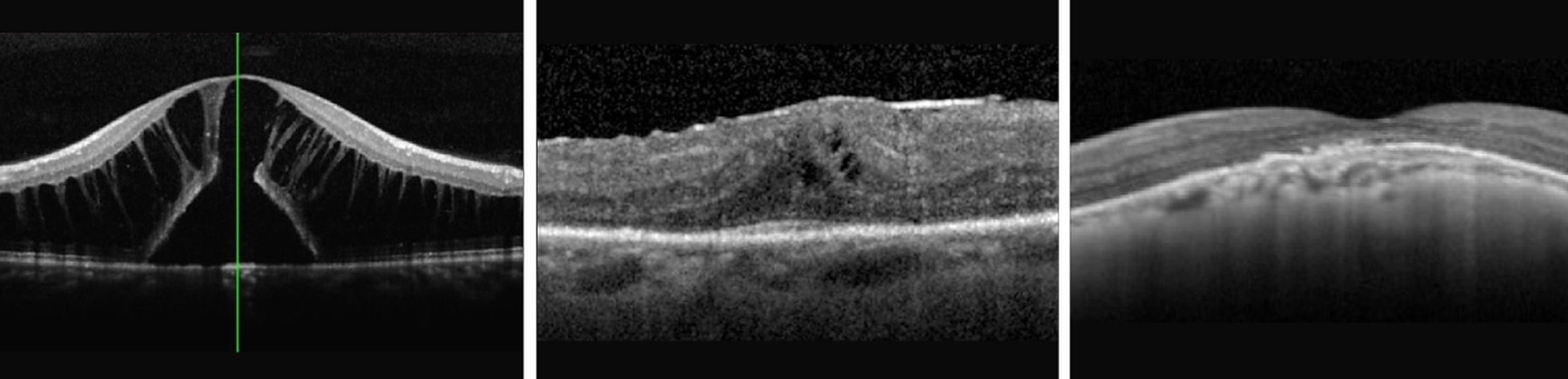 Place de l'OCT en pratique courante