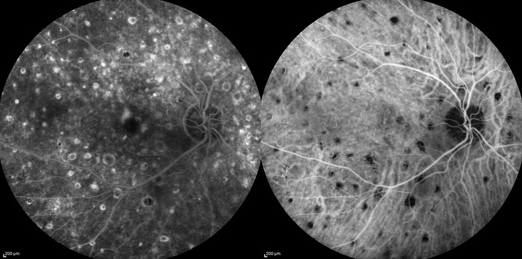 Diagnostic différentiel des néovaisseaux choroïdiens : tout n’est pas une DMLA