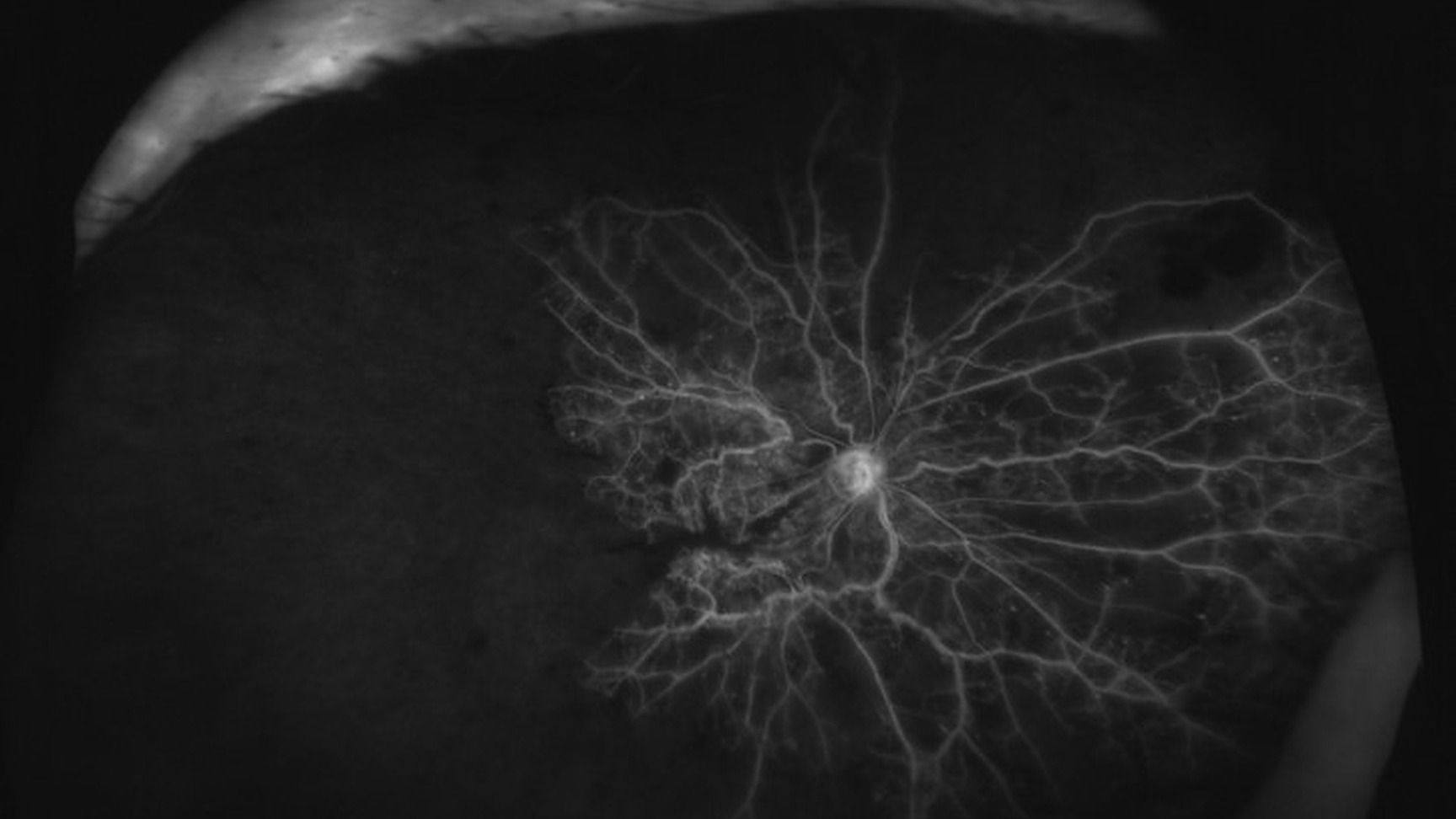 Anti-VEGF et pathologies rétiniennes (hors DMLA et diabète)