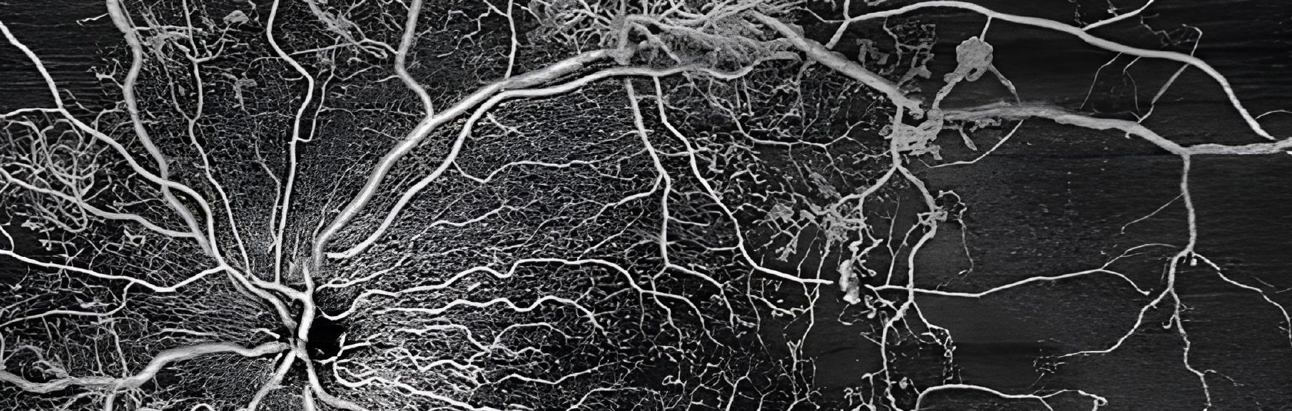 OCT-A et pathologies rétiniennes (hors DMLA)