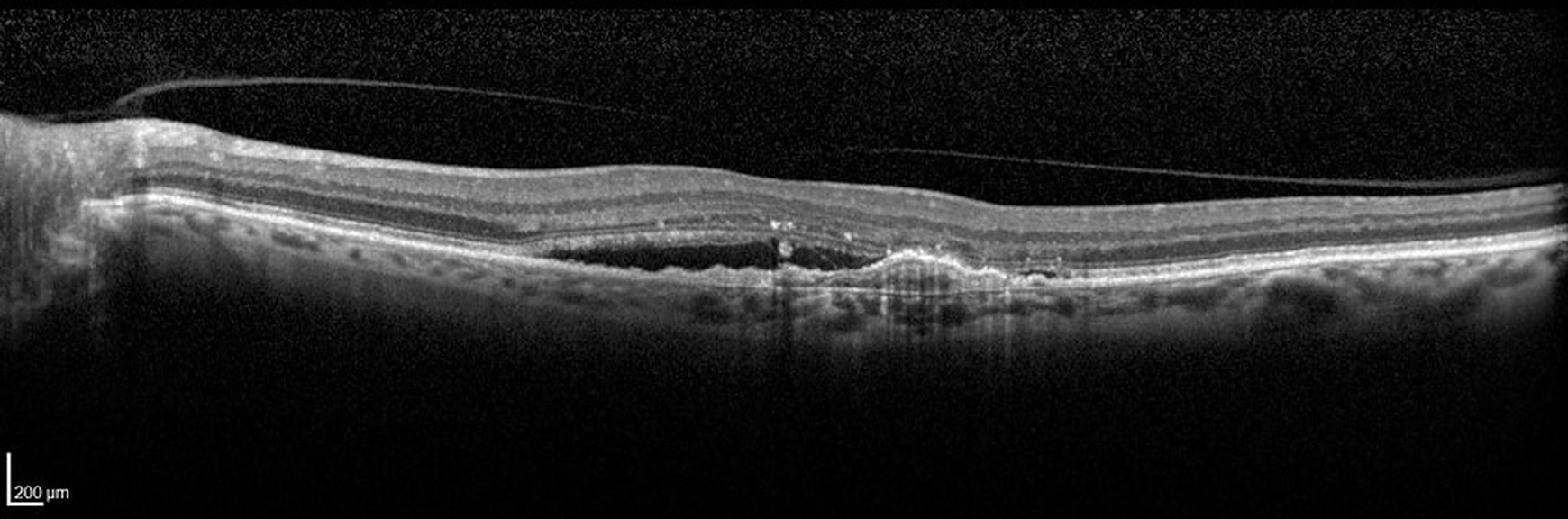 Les formes cliniques de la DMLA