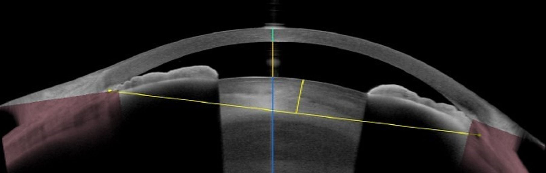 Formes cliniques et  prise en charge des glaucomes à angle fermé