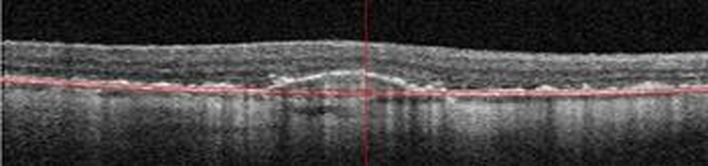 Place de la tomographie par cohérence optique OCT et l'OCT-Angiographie en pratique courante