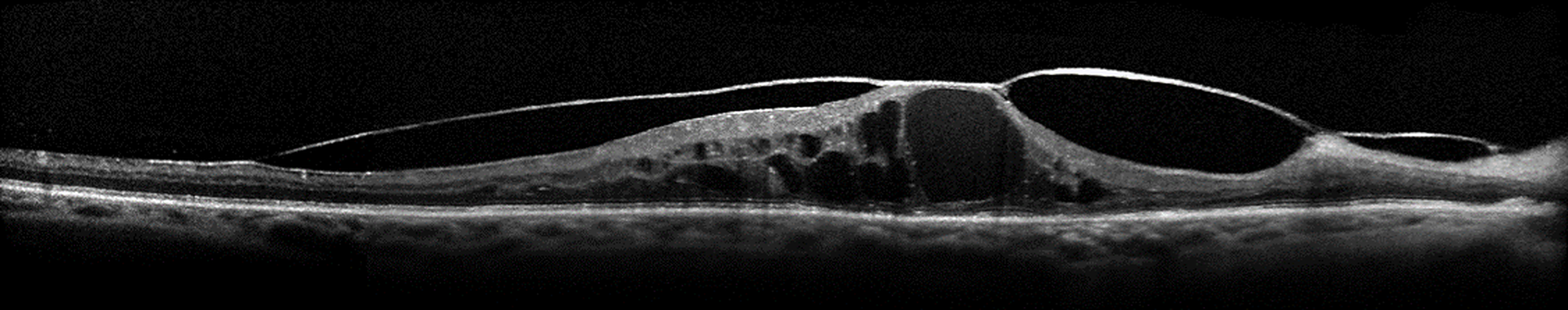 Traitements actuels de l’œdème maculaire diabétique et indications chirurgicales dans la rétinopathie diabétique