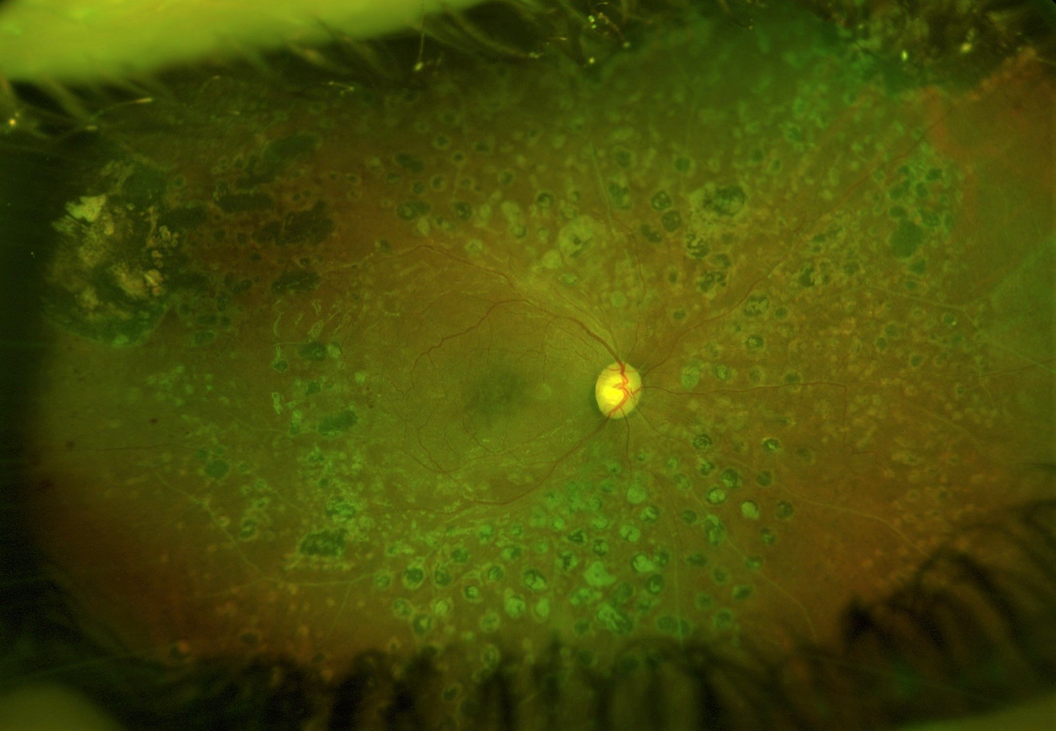 La rétinopathie diabétique